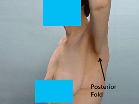 Patient photo showing posterior fold