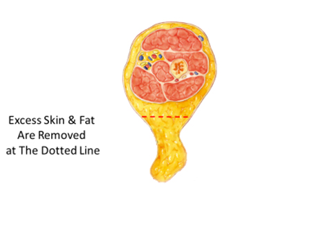 Excess skin and fat are removed at the dotted line