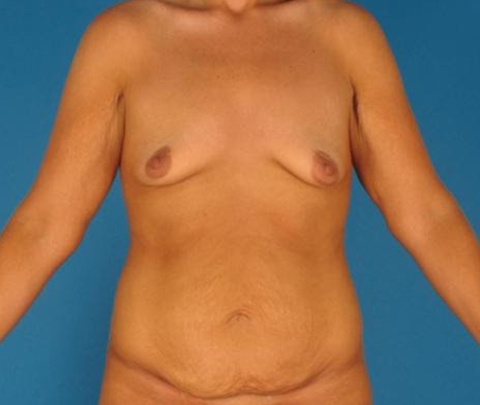 Breast Deformity 2
