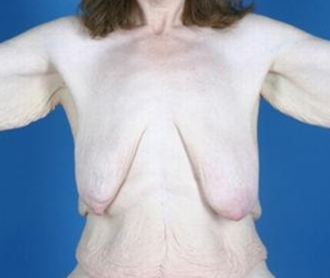 Breast Deformity 3
