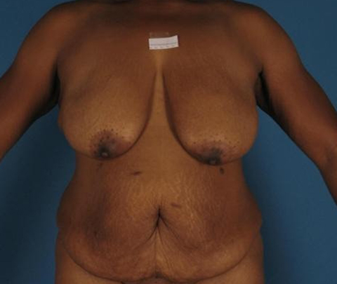 Breast Deformity 1