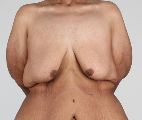 Breast Deformity 4