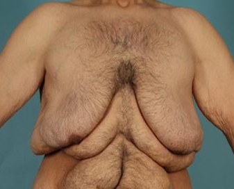 male chest deformities 03