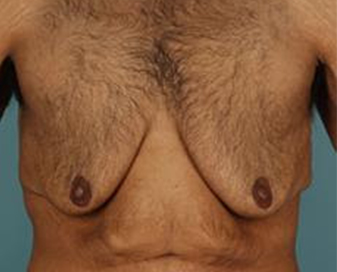 male chest deformities 03