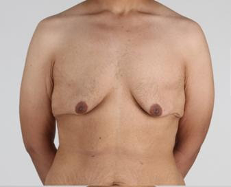 male chest deformities 01