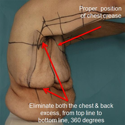 Upper body lift instructions labeled over a male patient - side view