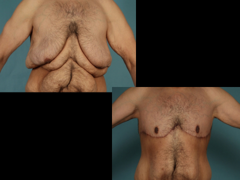 Before and after upper body lift on a male patient - front view