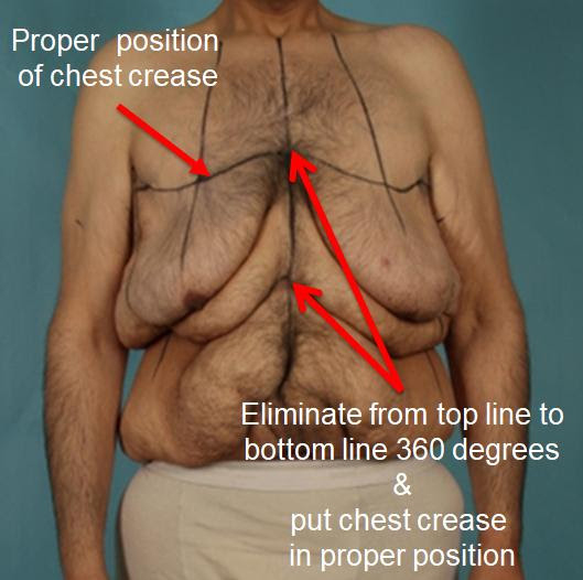 Upper body lift instructions labeled over a male patient - front view