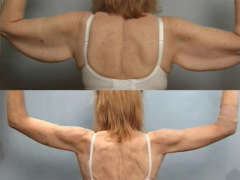 Patient with Arm lift surgery before and after 