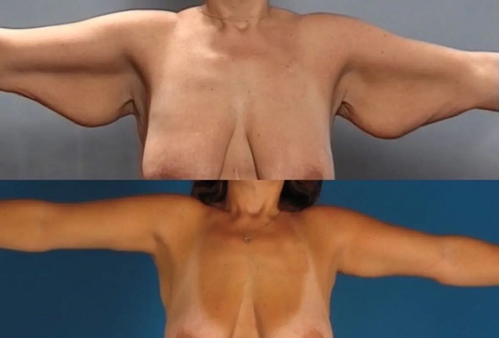 Patient with Arm lift surgery before and after photo