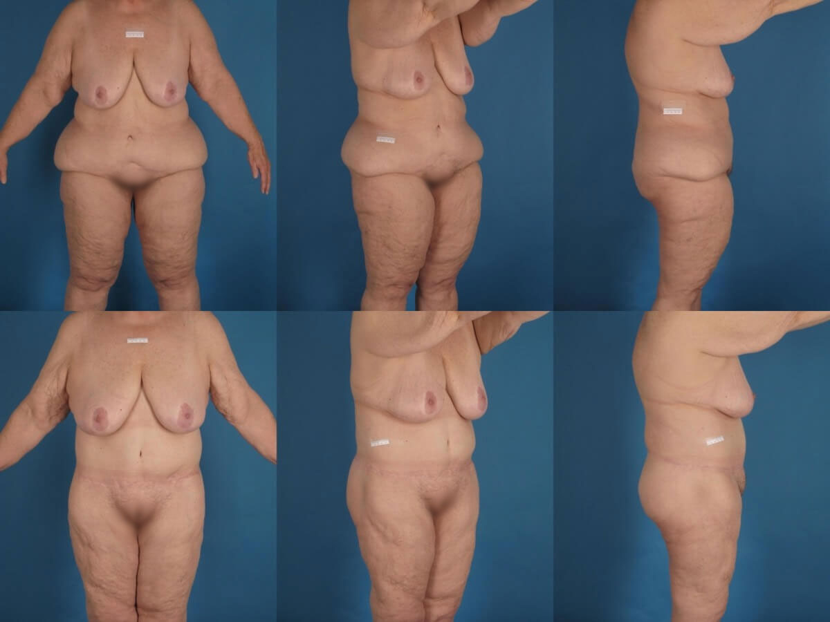 Belt Lipectomy Patient 06 - Dr. Aly - Body Contouring Specialist
